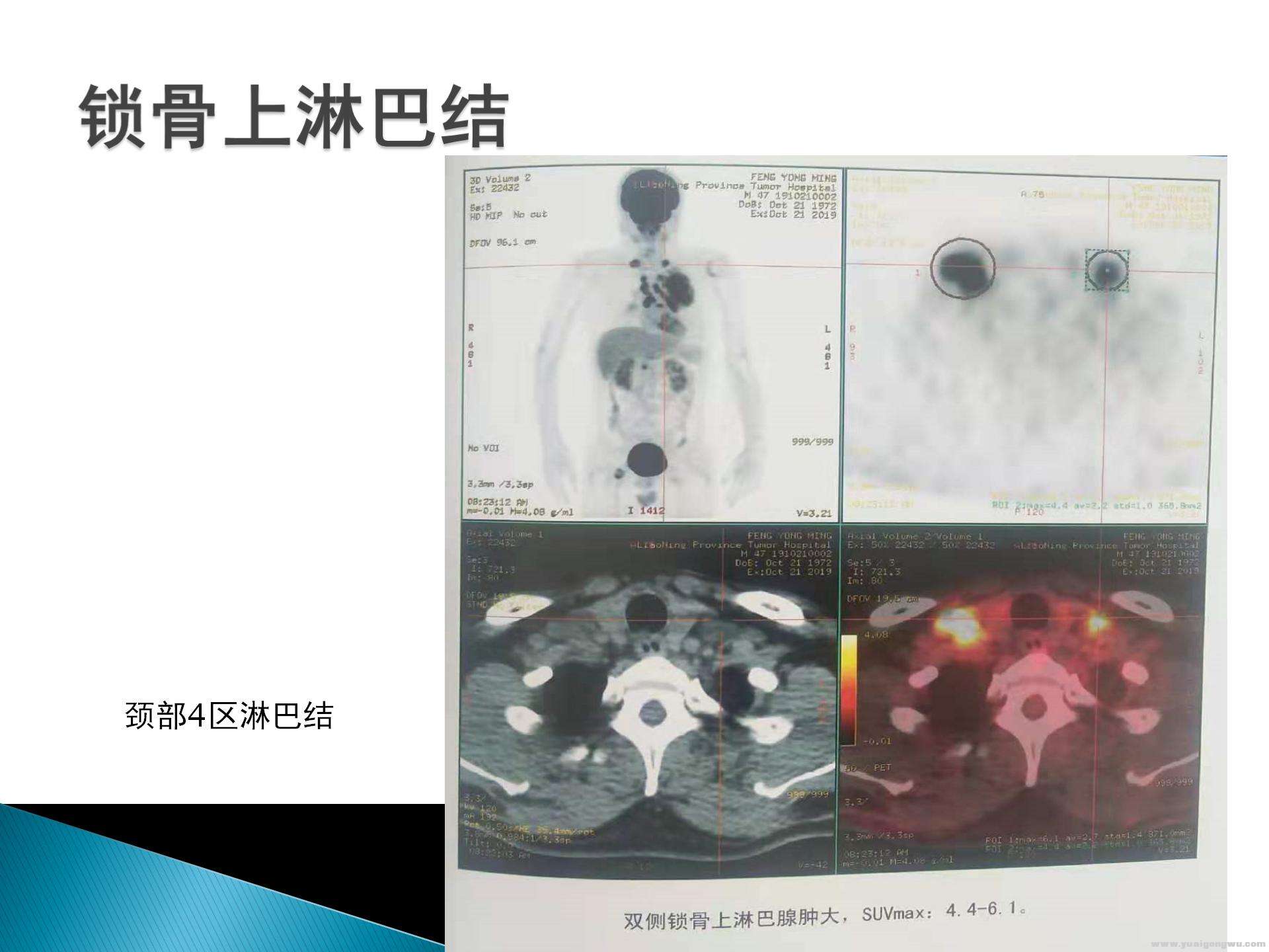 pd1病例讨论_08.jpg